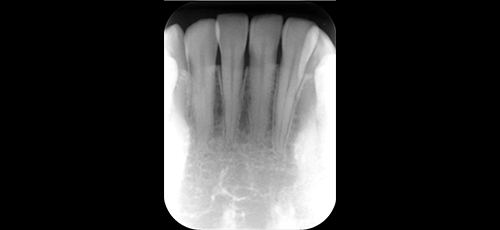 健康な歯ぐきの状態-2